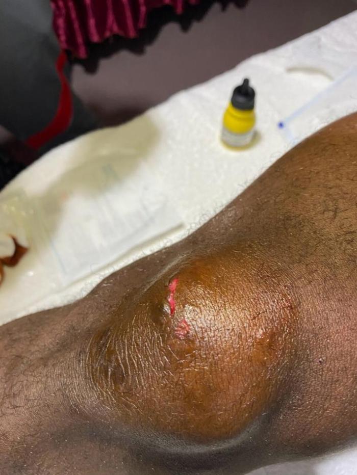 申花新闻官晒巴索戈肿胀膝盖, 伤口见肉